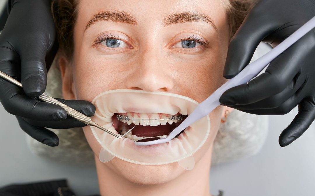 Braces Care Tips for a Smooth Orthodontic Journey