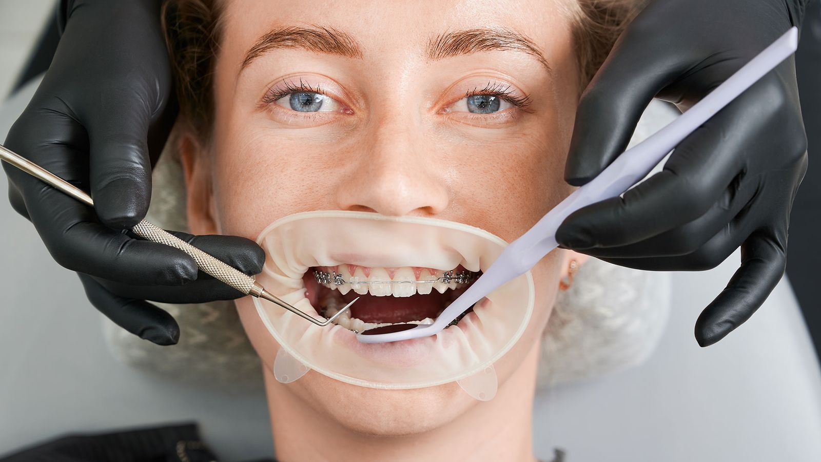 Braces Care Tips for a Smooth Orthodontic Journey
