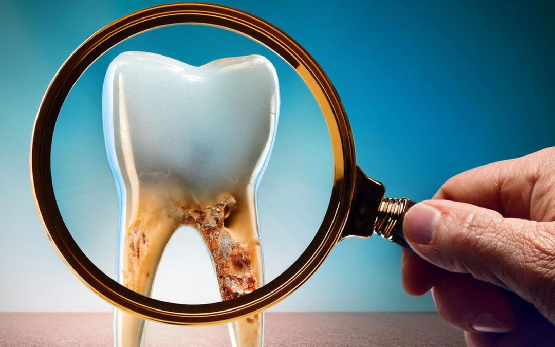 Understanding Tooth Decay and How to Prevent It