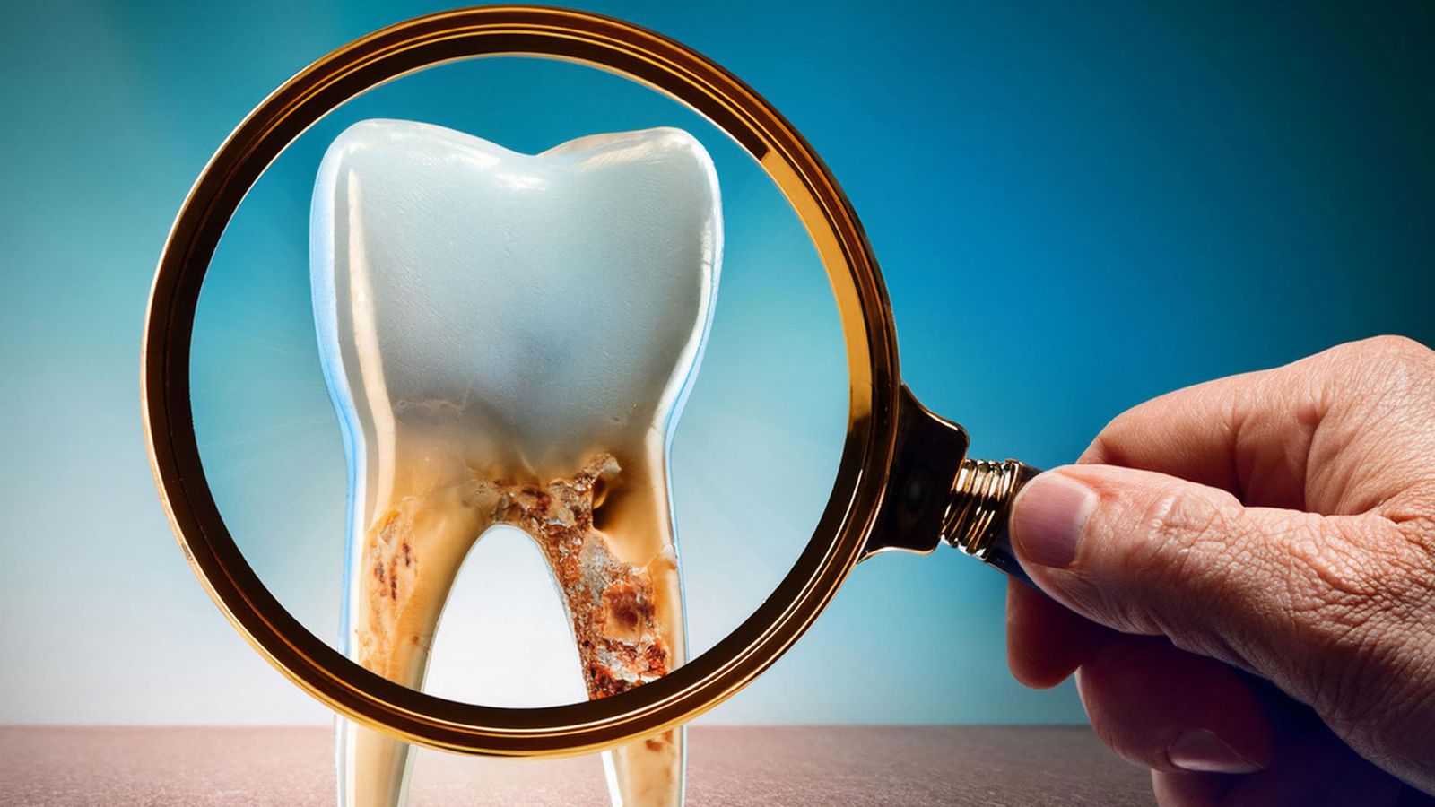Understanding Tooth Decay and How to Prevent It